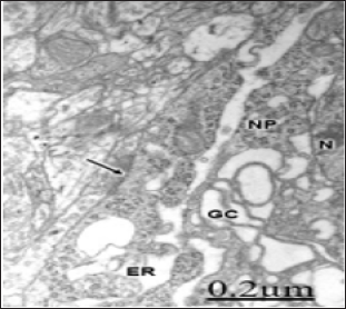 Click here to view Large Figure 1 biomedres-openaccess-journal-bjstr