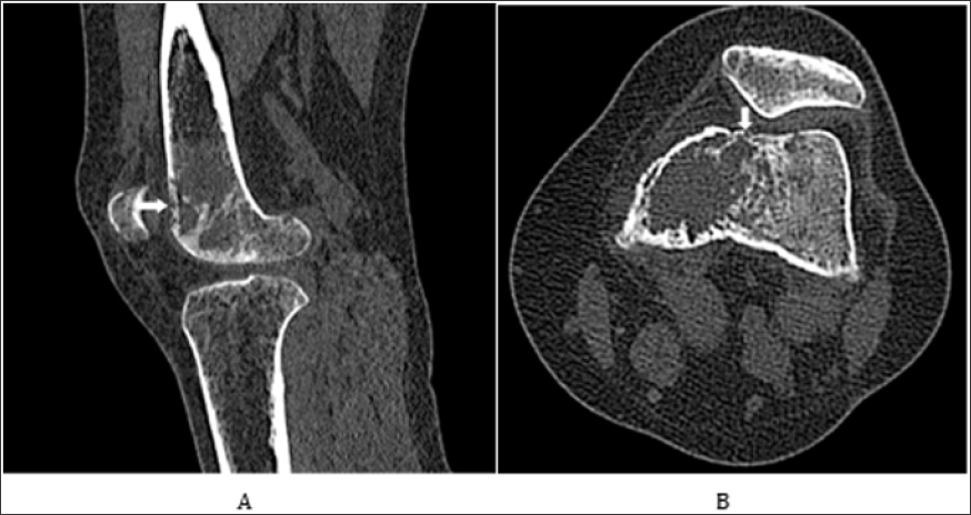 Click here to view Large Figure 2 biomedres-openaccess-journal-bjstr