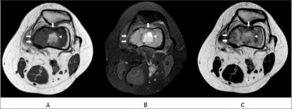 Click here to view Large Figure 3 biomedres-openaccess-journal-bjstr