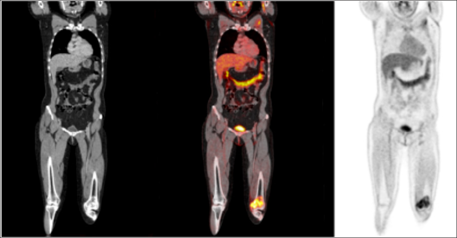 Click here to view Large Figure 5 biomedres-openaccess-journal-bjstr