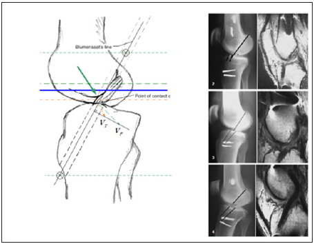 Click here to view Large Figure 1 biomedres-openaccess-journal-bjstr