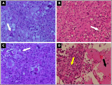 Click here to view Large Figure 3 biomedres-openaccess-journal-bjstr
