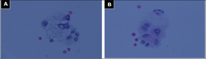 Click here to view Large Figure 3 biomedres-openaccess-journal-bjstr
