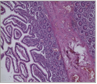 Click here to view Large Figure 3 biomedres-openaccess-journal-bjstr