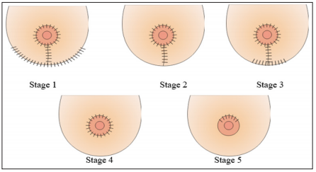 Click here to view Large Figure 2 biomedres-openaccess-journal-bjstr