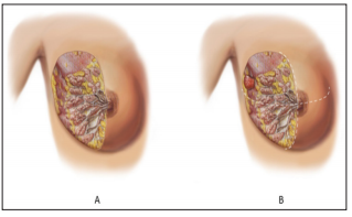 Click here to view Large Figure 3 biomedres-openaccess-journal-bjstr