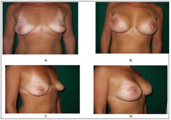 Click here to view Large Figure 8 biomedres-openaccess-journal-bjstr