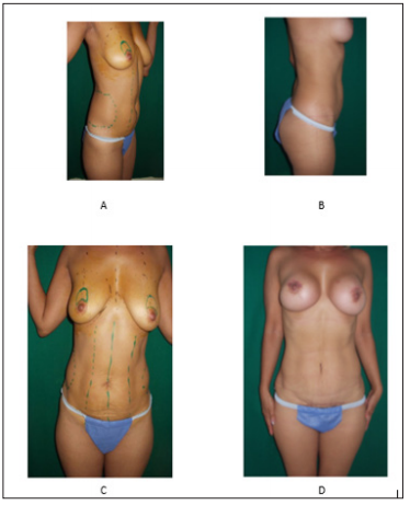 Click here to view Large Figure 10 biomedres-openaccess-journal-bjstr