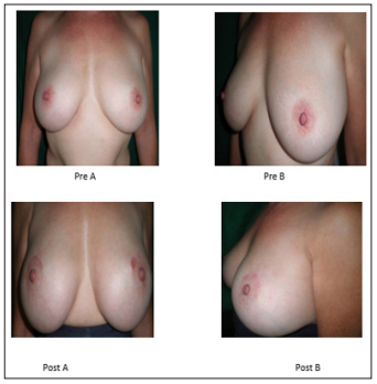Click here to view Large Figure 11 biomedres-openaccess-journal-bjstr