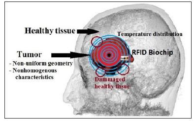 Click here to view Large Figure 1 biomedres-openaccess-journal-bjstr