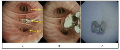 Click here to view Large Figure 3 biomedres-openaccess-journal-bjstr