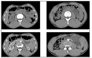 Click here to view Large Figure 2 biomedres-openaccess-journal-bjstr