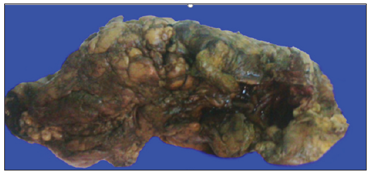Click here to view Large Figure 1 biomedres-openaccess-journal-bjstr