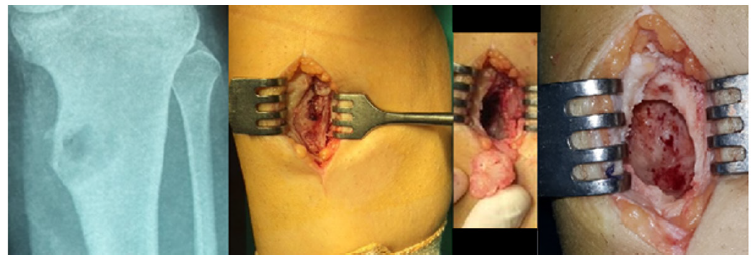 Click here to view Large Figure 4 biomedres-openaccess-journal-bjstr