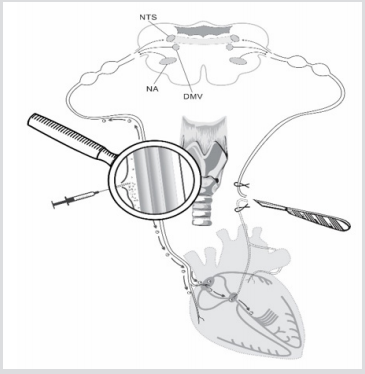 Click here to view Large Figure 1 biomedres-openaccess-journal-bjstr