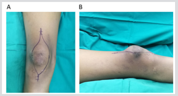 biomedres-openaccess-journal-bjstr