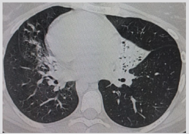biomedres-openaccess-journal-bjstr