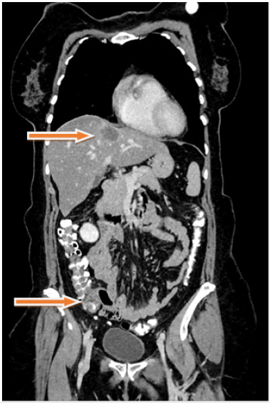 biomedres-openaccess-journal-bjstr