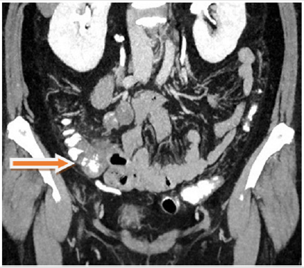 biomedres-openaccess-journal-bjstr