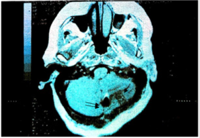 biomedres-openaccess-journal-bjstr
