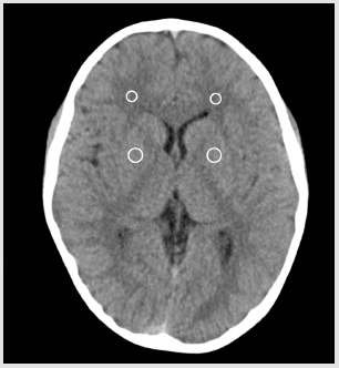 biomedres-openaccess-journal-bjstr