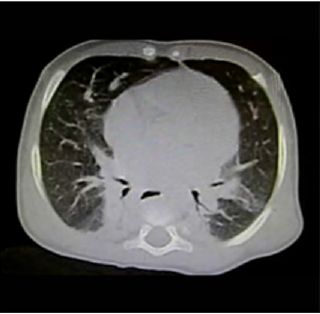 biomedres-openaccess-journal-bjstr