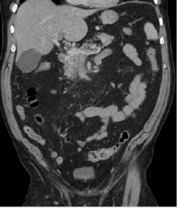 biomedres-openaccess-journal-bjstr
