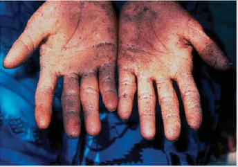 biomedres-openaccess-journal-bjstr