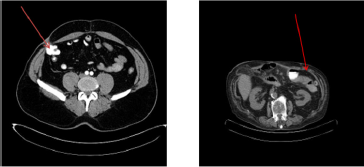 biomedres-openaccess-journal-bjstr