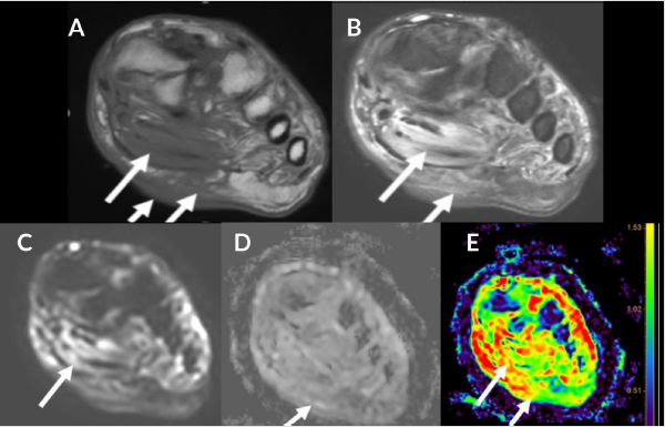 biomedres-openaccess-journal-bjstr