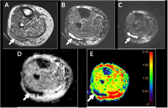 biomedres-openaccess-journal-bjstr