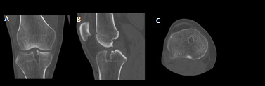 biomedres-openaccess-journal-bjstr