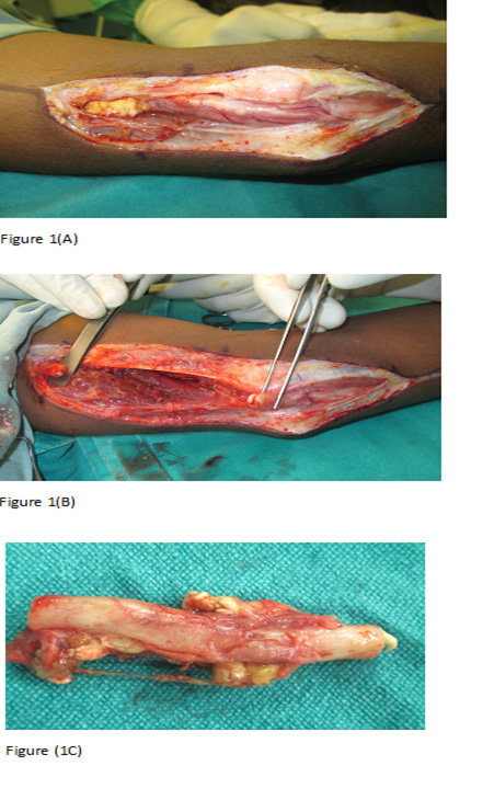 Click here to view Large Figure 1 biomedres-openaccess-journal-bjstr