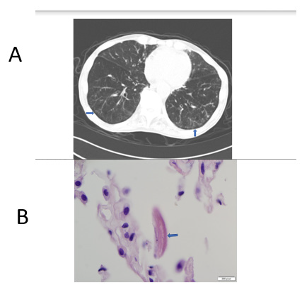 Click here to view Large Figure 1 biomedres-openaccess-journal-bjstr