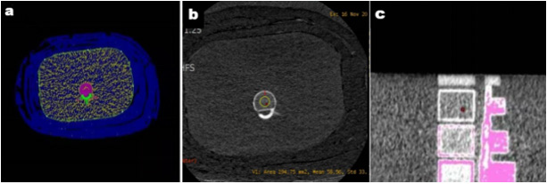 Click here to view Large Figure 1 biomedres-openaccess-journal-bjstr