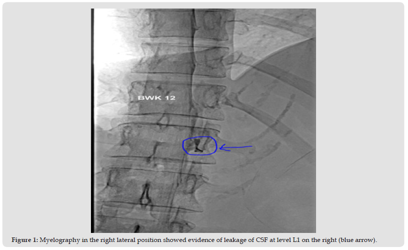 Click here to view Large Figure 1 biomedres-openaccess-journal-bjstr