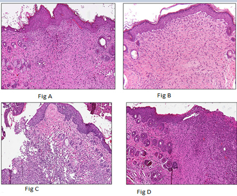 Click here to view Large Figure 2 biomedres-openaccess-journal-bjstr