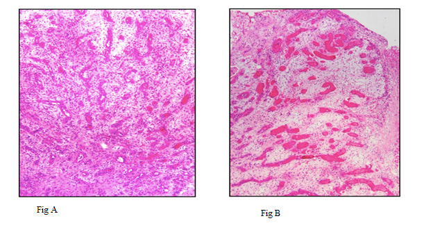 Click here to view Large Figure 3 biomedres-openaccess-journal-bjstr