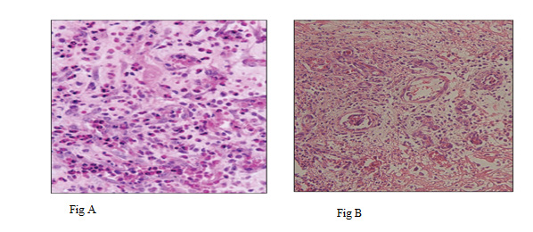 Click here to view Large Figure 4 biomedres-openaccess-journal-bjstr