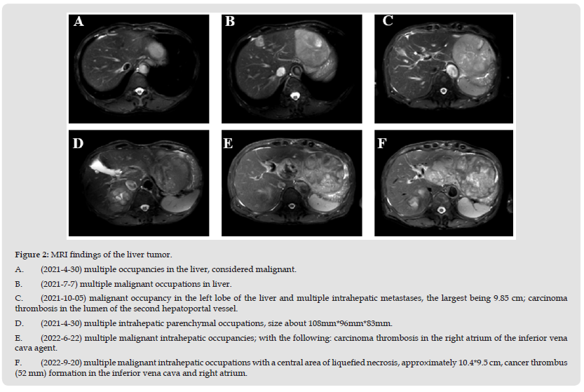 Click here to view Large Figure 2 biomedres-openaccess-journal-bjstr