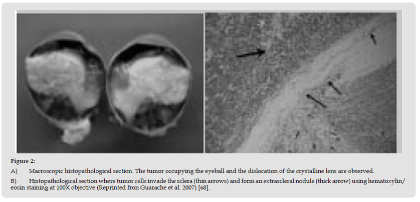 Click here to view Large Figure 2 biomedres-openaccess-journal-bjstr