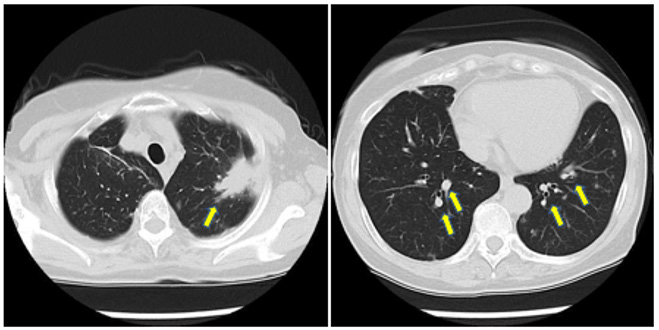 Click here to view Large Figure 1 biomedres-openaccess-journal-bjstr